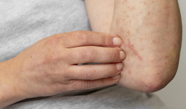 Un estudio vincula la vacuna anticovid de Moderna con casos marginales de urticaria