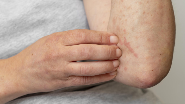 Reaccinurticaria