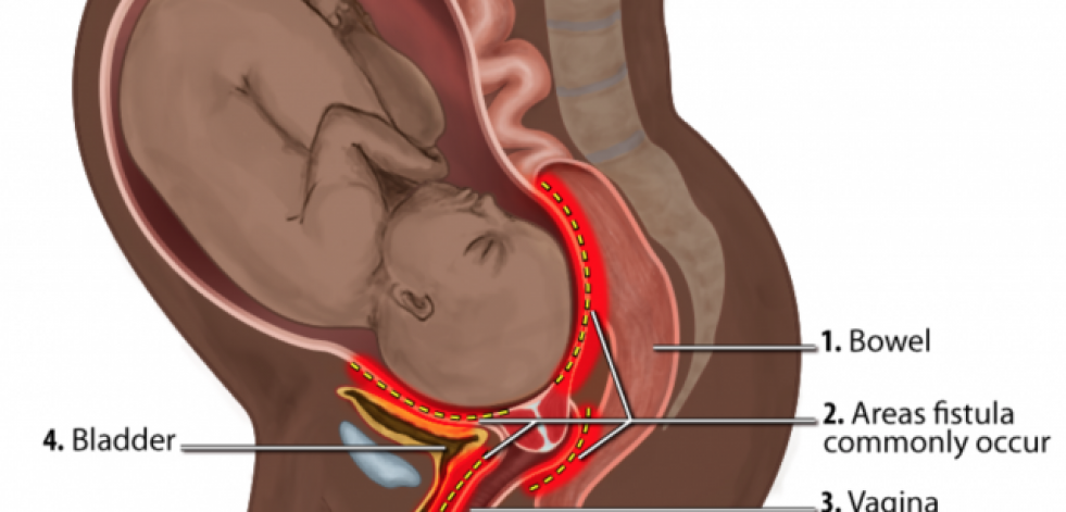 ¿Qué es la fístula obstétrica y cómo combatirla?