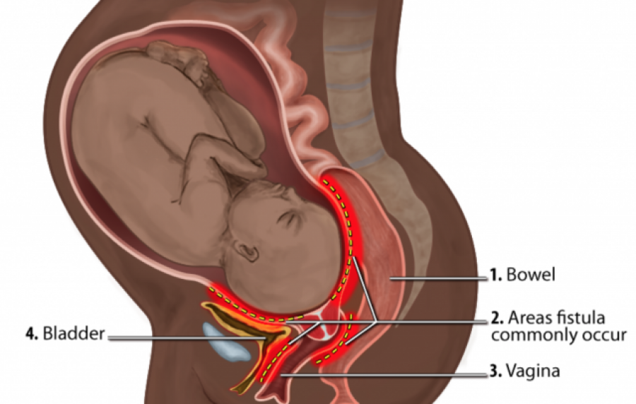 ¿Qué es la fístula obstétrica y cómo combatirla?