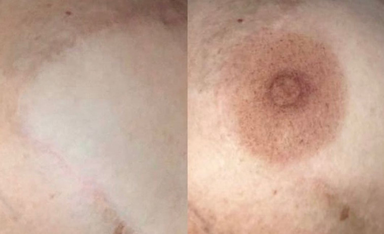 Micropigmentacion en él área de la salud: pequeños cambios que mejoran la autoestima