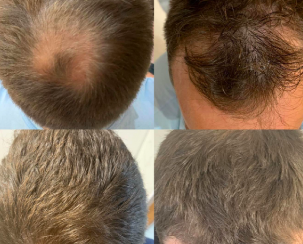 La alopecia o caída del pelo